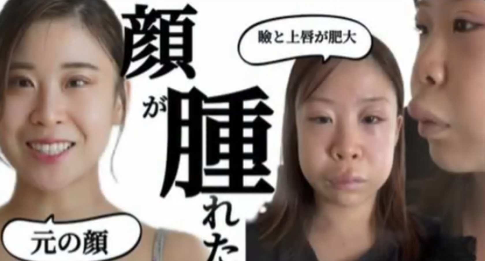 まいも - 顔が腫れてしまった経験から学んだこと